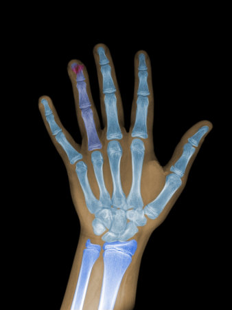 x ray hand. X-Ray of a Human 12 Year Old
