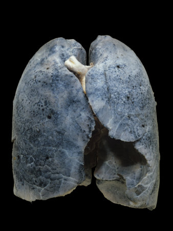 damaged lungs. A Smoker#39;s Damaged Lungs