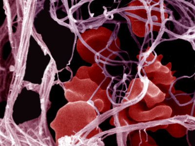 Showing Rooms  Wall on Blood Clot Formation  Showing Trapped Red Blood Cells Or Erythrocytes