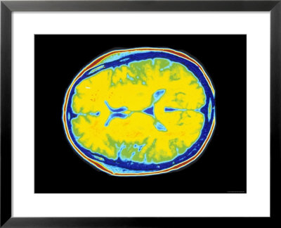 Ct+scan+brain+normal
