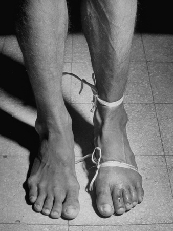 Snake Bite Victim Having Wound Treated with Tourniquet Stretched Canvas Print