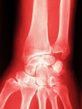 X-ray of a Wrist