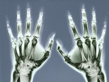 X-ray of Hands