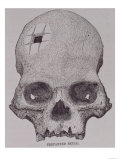 Trepanned Skull  from Incidents of Travel and Exploration in the Land of the Incas