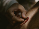 Man Removing a Leech from his Arm