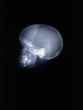 X-Ray of Skull