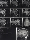 X-Ray Photographs of Person's Skull