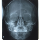 X-Ray Photograph of Skull