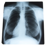 X-Ray Photograph of Person's Lungs