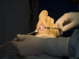 A Screw is Visible Holiding the Bone of a Foot Together