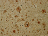 Alzheimers Disease  Bielchowsky Stain X64