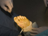 A Foot Gets Sewn Back up with Stitches after Surgery  Washington  District of Columbia
