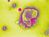 Respiratory Syncytial Virus Rsv Infection