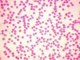 Pernicious Anemia X100 Addison S Disease