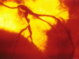 Coronary Angiogram Left Anterior Decending Artery