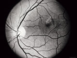 Clinical Central Serous Choroidopathy Os
