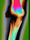 Broken Elbow X-Ray Child Accident