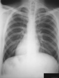 Bronchitis Chest X-Ray Adult