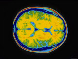 Normal MRI Head Transverse Magnetic Resonance Image
