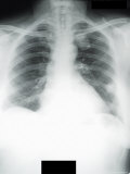 X-Ray Lung Metastatic Sarcoma to Lungs