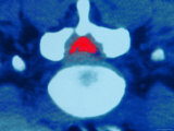 Hernia on Disc in Back Lumbar Cartilage