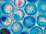 Virology Electron Micrograph Herpes Simplex Viruses Acute Eruption Blisters