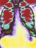 Lungs Chest X-Ray