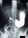X-Ray Peptic Ulcer of the Stomach