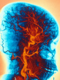 Angiogram  Human Head  Vessels