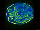 Computer Aided Tomography Imaging Plane Brain Ct