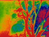 Pulmonary Angiogram Abnormal