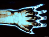 X-Ray Normal Wrist Hand Mouse Keyboard Use Injury