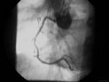 Cardiac Cath  Angiogram Normal Rt Coronary Artery
