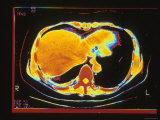Ct+scan+abdomen+normal