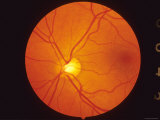 Normal Retina View Thru Fundus