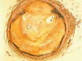 Photomicrograph Occluded Coronary Artery Show Plaque Build Up