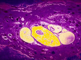 Cervical Cancer X400 Mag Vaculated Epithelium