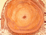 Cross Section Occluded Coronary Artery