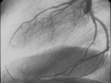 Normal Coronaries Left System Lateral View