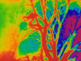 Pulmonary Angiogram Abnormal