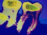 X-Ray of Two Teeth in Jaw in Color