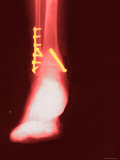 Bone Brace Xray Enhanced Red Surgically Implanted