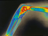 Digitized X-Ray of Normal Human Elbow