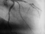 Right Anterior Oblique after Atherectomy of Lad