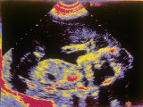 Digitized Fetal Ultrasound 4Th Month Normal Pregnancy