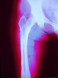 Leg Bone Colorized Xray Abdomen Pelvis Femur Joint