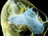 Sem Wisdom Tooth with Amalgam Filling  Enhanced