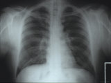 Chest X-Ray Atelectasis Vs Lung Infiltrate
