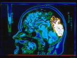Magnetic Resonance Imaging Lateral View of Head