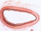 100 Year Old Woman Artery Clean No Plaque